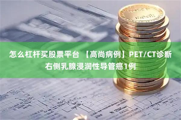 怎么杠杆买股票平台 【高尚病例】PET/CT诊断右侧乳腺浸润性导管癌1例